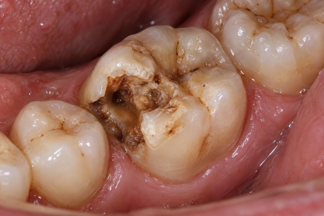 Extensive visible breakdown in a back tooth
