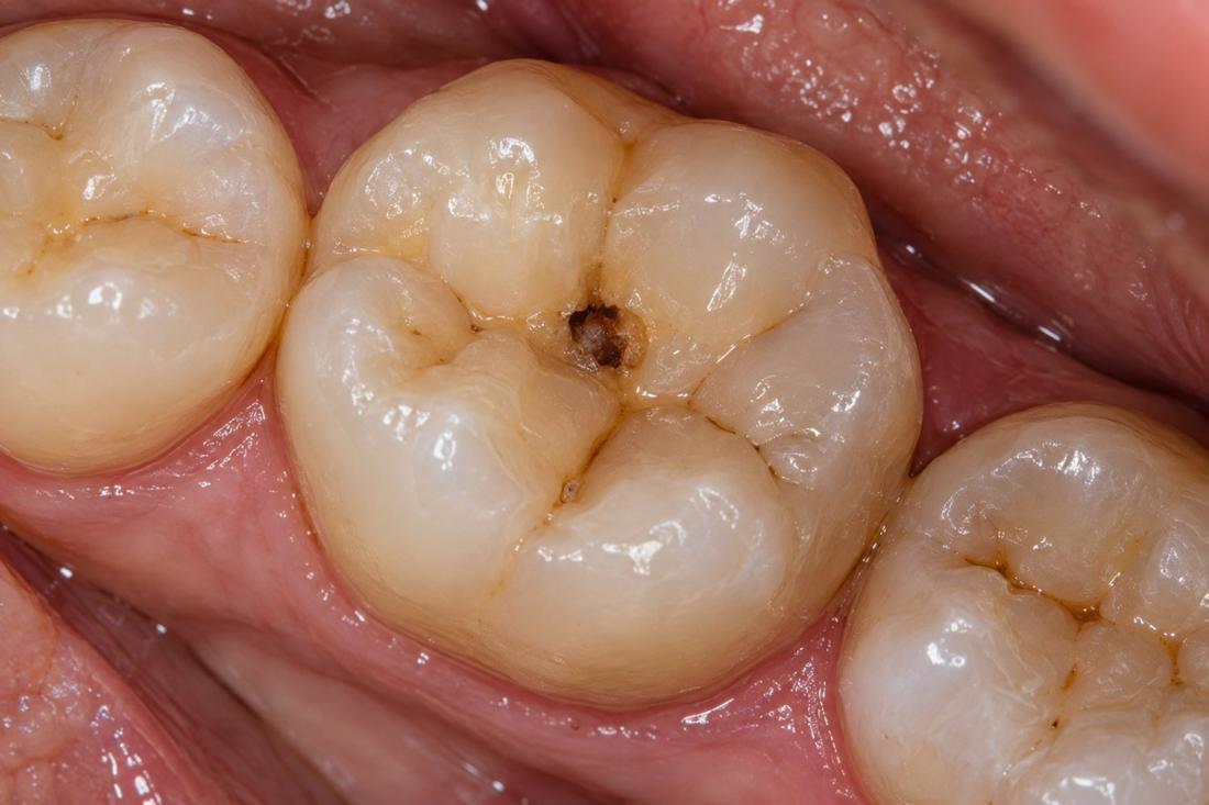 A small visible cavity in a back tooth