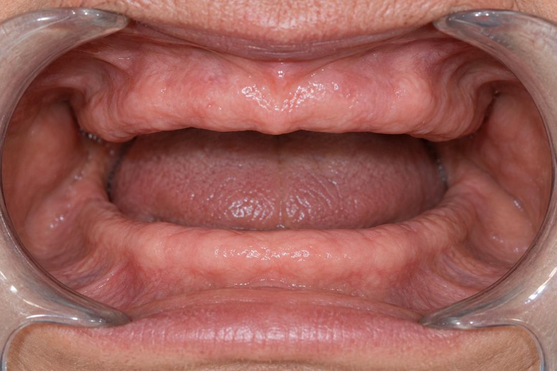 An upper arch with no natural teeth