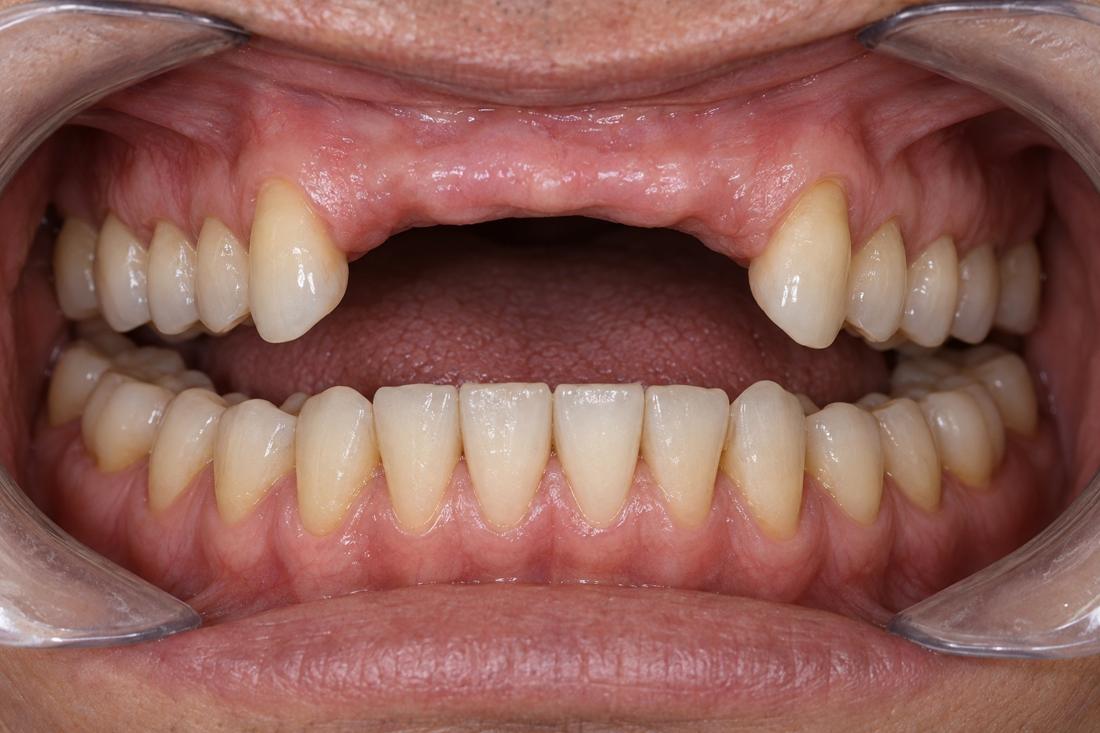Several missing upper teeth