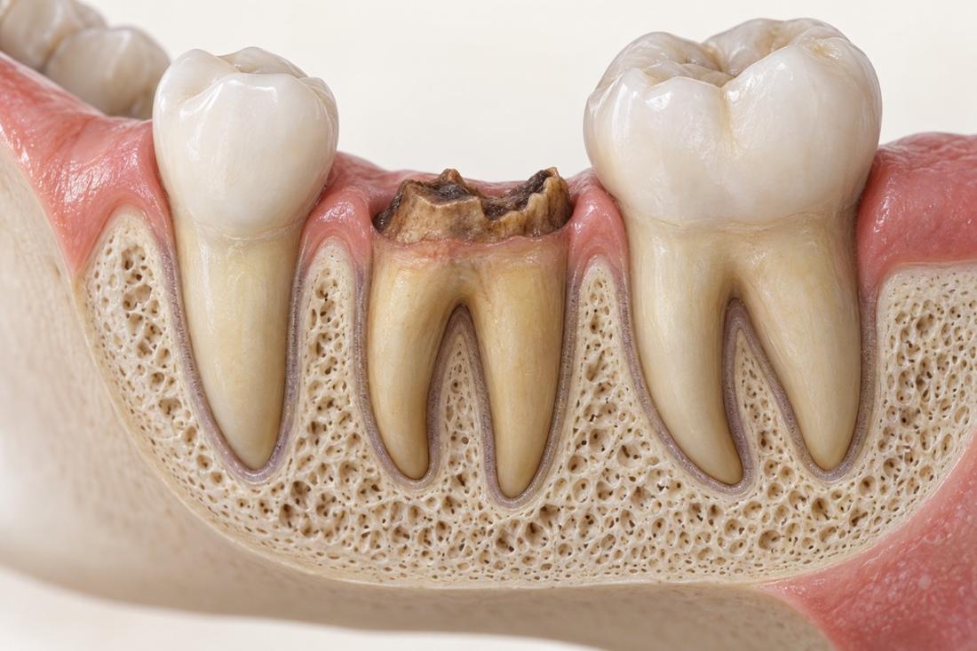 Illustration of a tooth broken near the gum line
