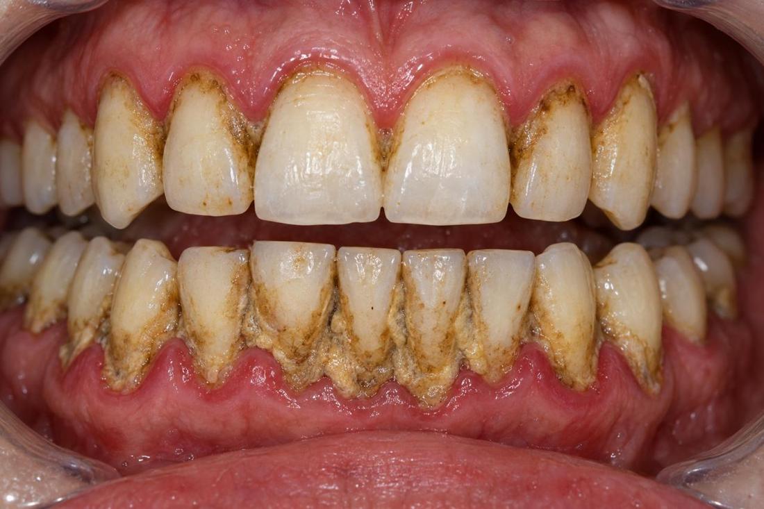 Extensive visible deposits around the lower teeth