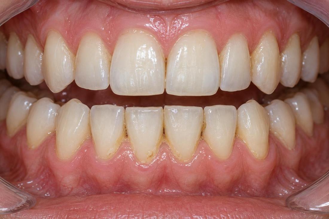 Light visible deposits around the lower front teeth
