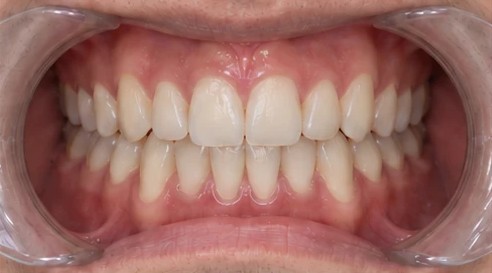 Straight teeth after braces, close-up