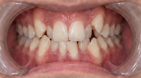 Crowded teeth before braces, close-up