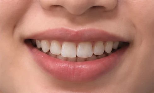Gap closed after braces, close-up
