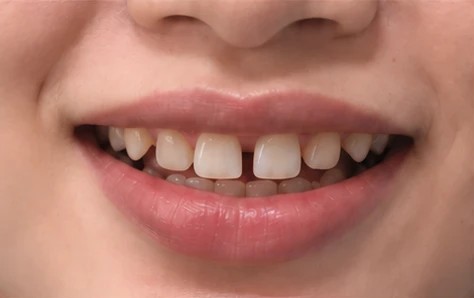 Gap between front teeth before braces, close-up